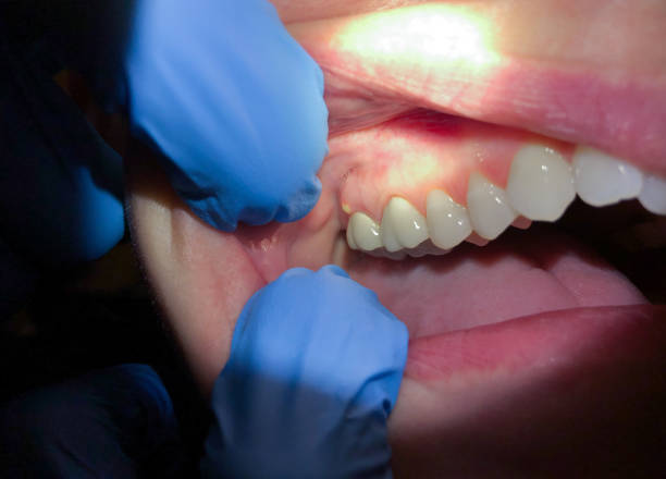 Best Dental Abscess Treatment in Avoca, IA